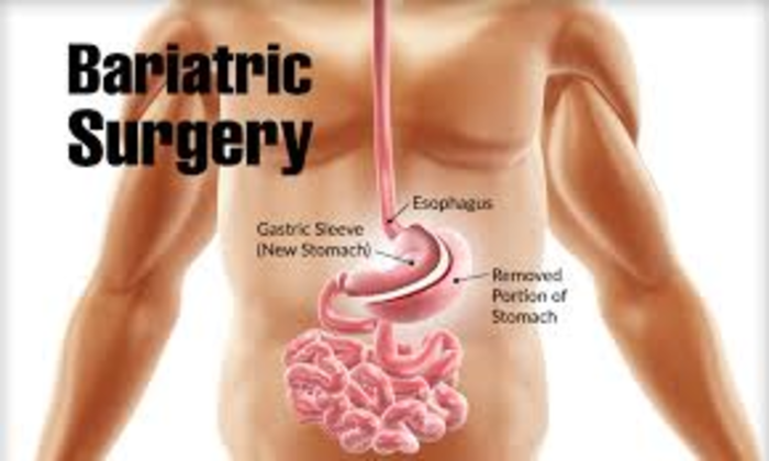 Is Bariatric Surgery an option for you?